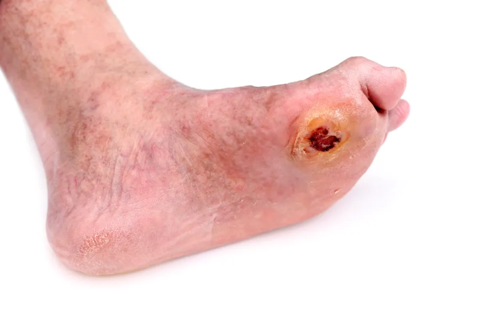 Early stage diabetic foot ulcer